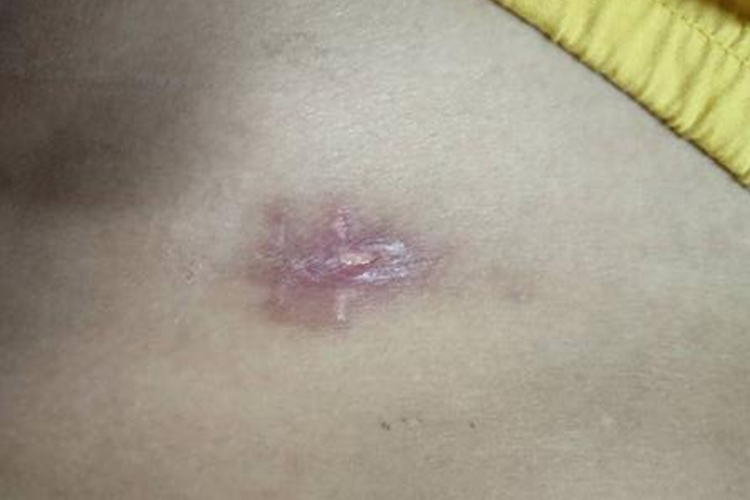 腹腔镜术后20天伤口恢复图