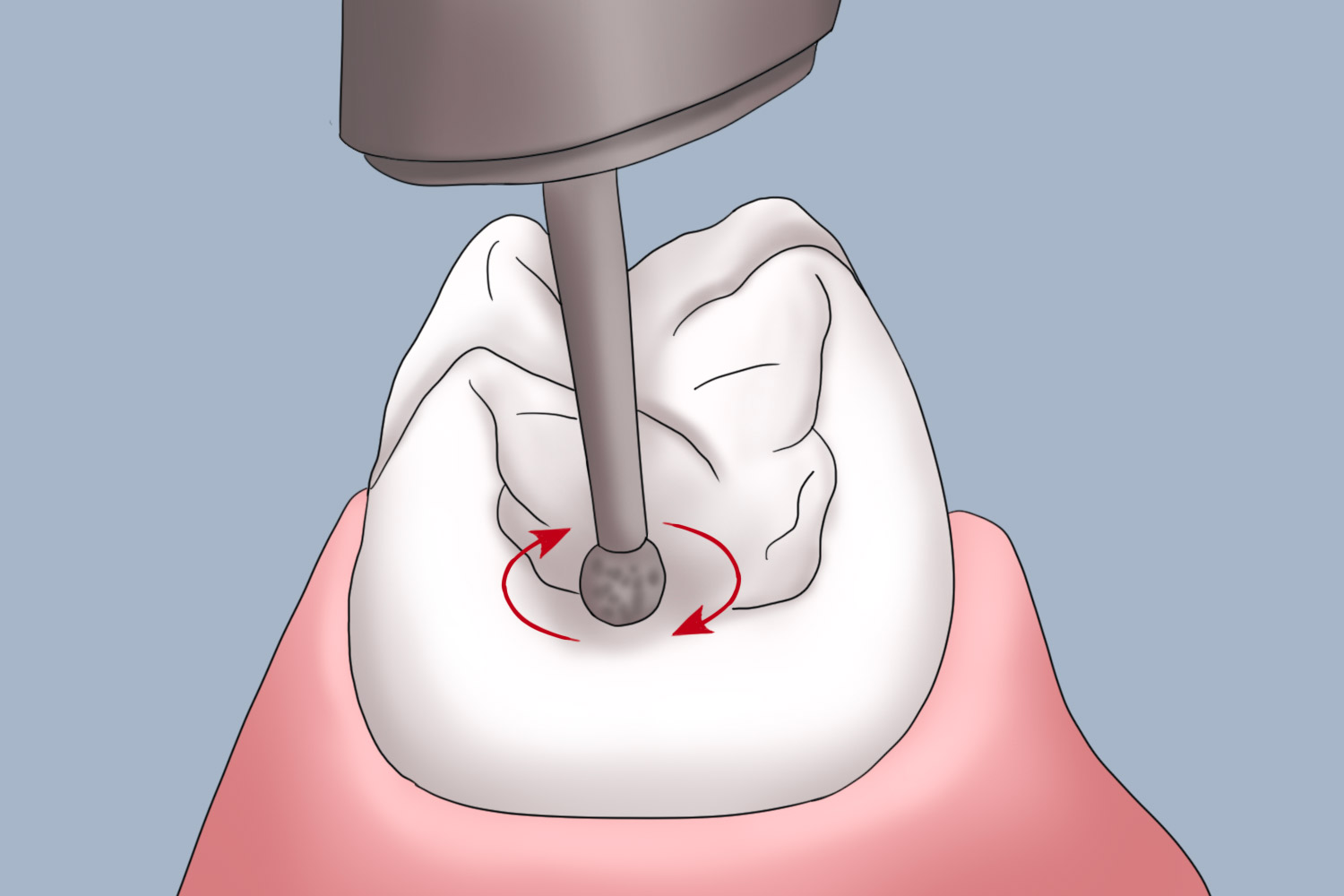 基牙和余留牙的调磨图