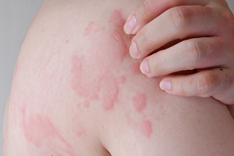 荨麻疹性血管炎风团图