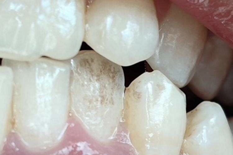 牙齿色素沉着斑图