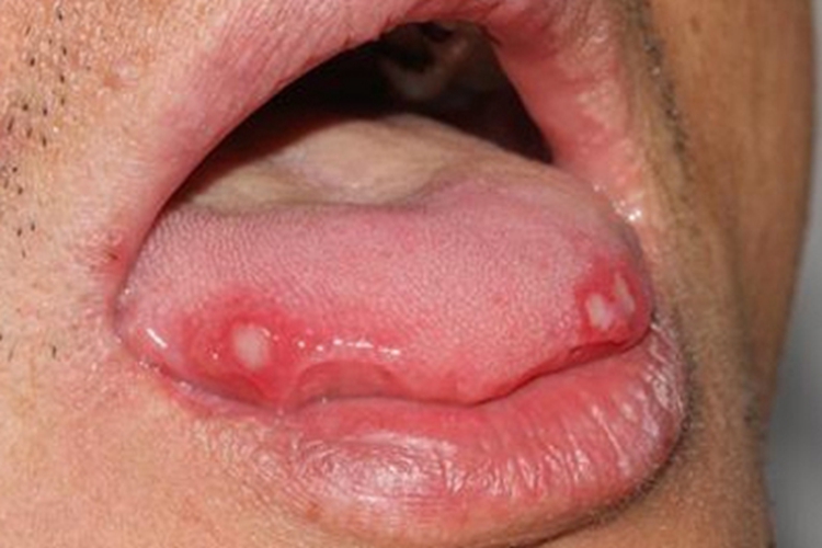 轻型复发性阿弗他口腔炎症状图