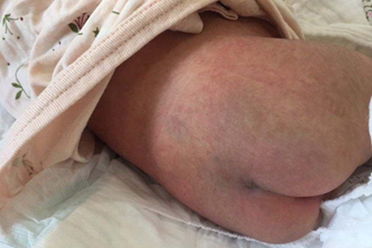 新生儿水肿腰部肿了图 新生儿水肿腰部肿了图