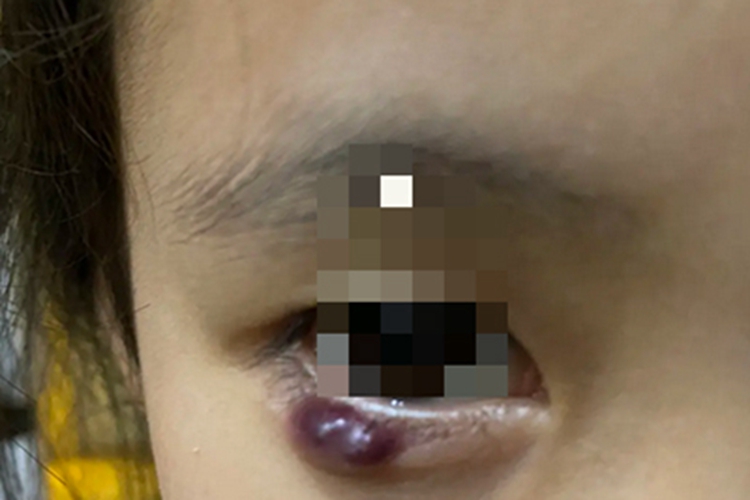 霰粒肿下眼睑肿紫色的肿块图