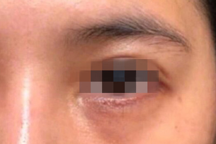 眶周色素沉着症眼周皮肤发黑图