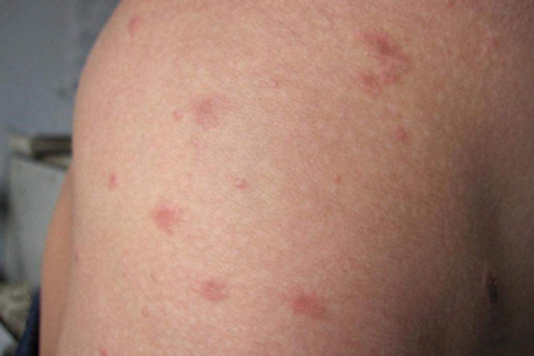 流行性斑疹伤寒红点图