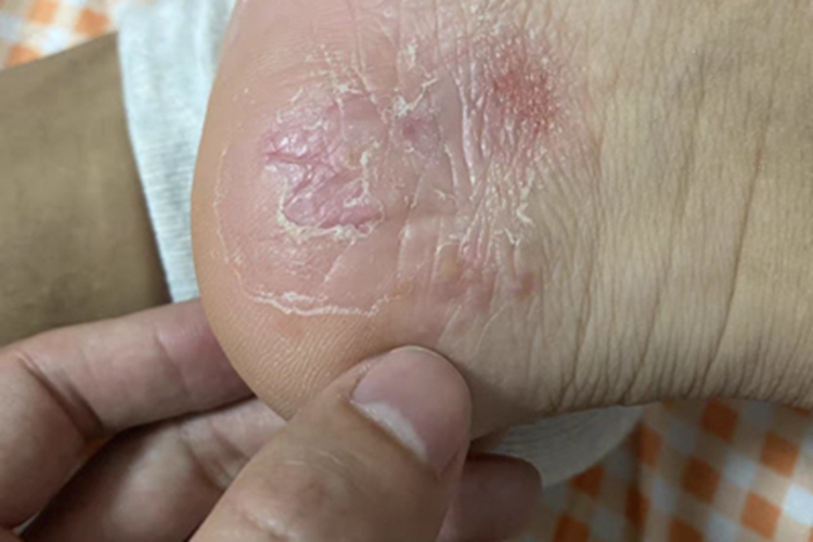 浸渍糜烂型足癣脚后跟症状图 浸渍糜烂型足癣脚后跟症状图