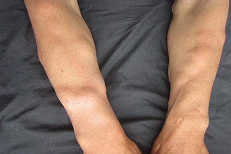 血管脂肪瘤疙瘩图 血管脂肪瘤疙瘩图