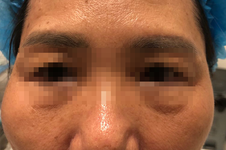 结构性黑眼圈图