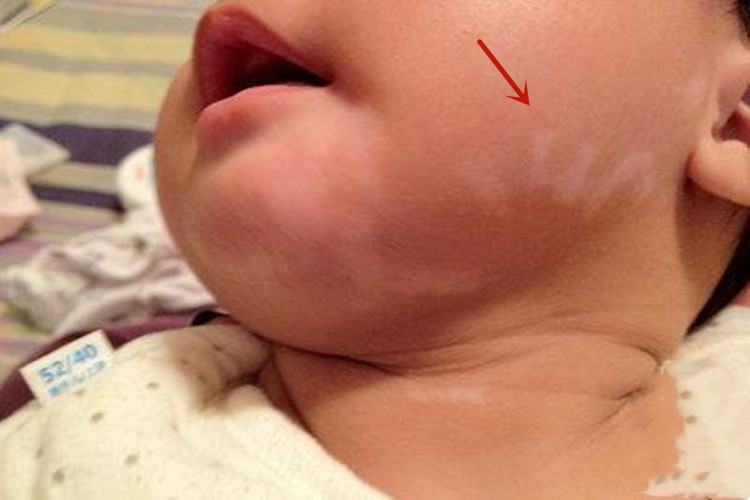 蛔虫病面部白斑图 蛔虫病面部白斑图