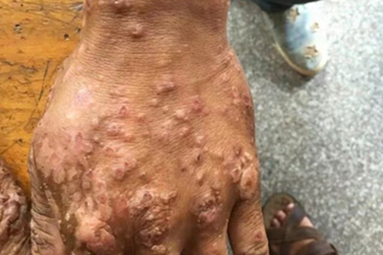 结节性痒疹手背大疙瘩图