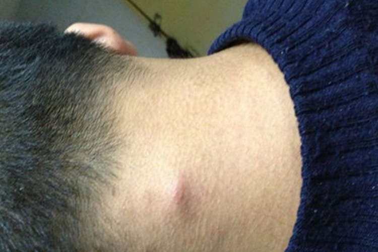 艾滋病初期枕部淋巴结肿大图