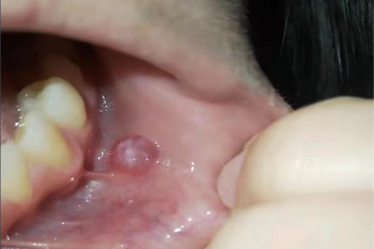 外渗性黏液囊肿唇内侧小疙瘩图