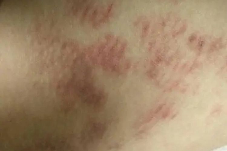 大腿抓痒抓出淤血皮炎图 大腿抓痒抓出淤血皮炎图