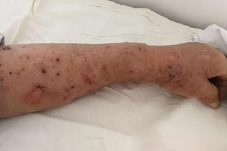 副肿瘤性天疱疮胳膊脱屑图