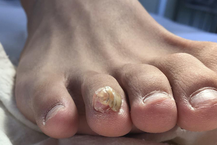 早期甲母痣恶变的斑块结节图