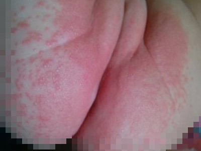 尿布疹 (18)