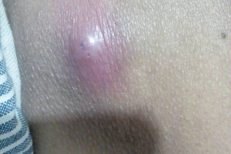 疖肚子上长红疙瘩图