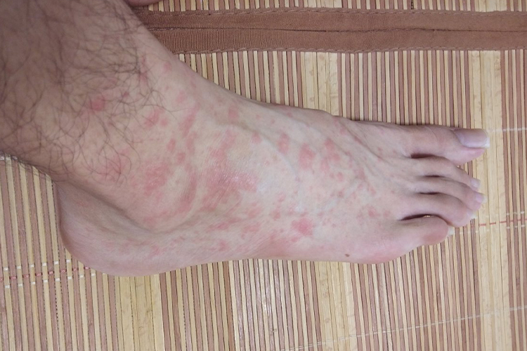脚部荨麻疹图 脚部荨麻疹图