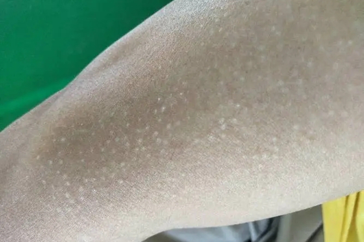 毛周角化病图