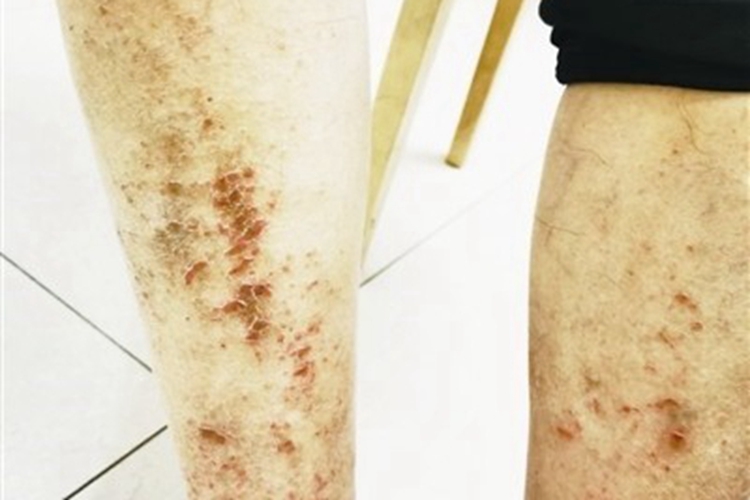 皲裂性湿疹小腿症状图