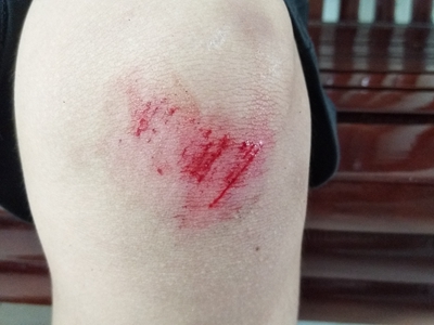 跌伤膝盖上有多道斜形擦痕裂口并出血图.jpg