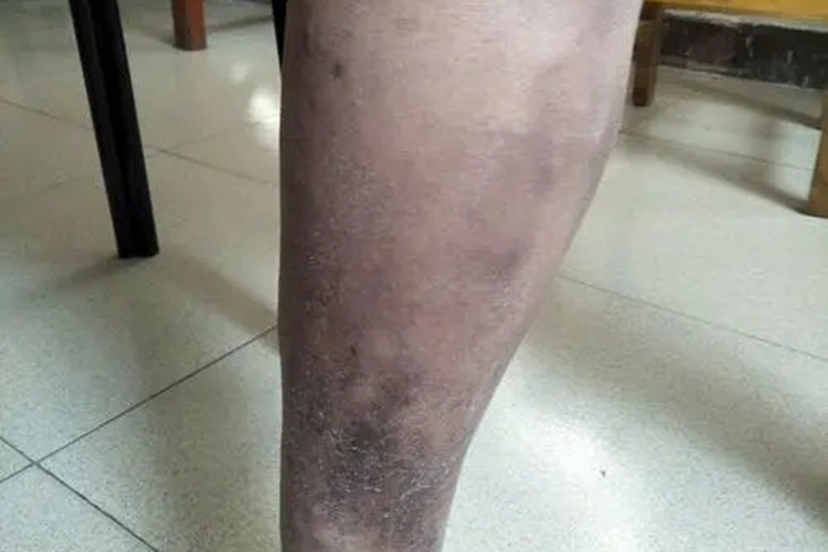 小腿色素沉着图