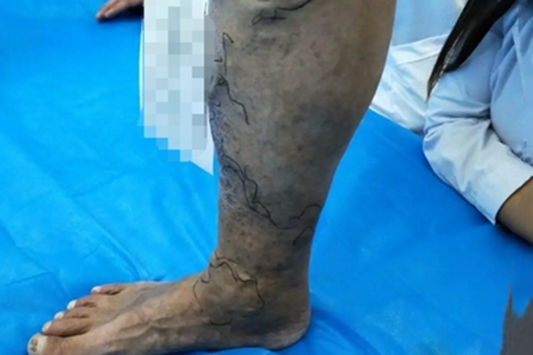 游走性血栓性浅静脉炎小腿皮肤发黑图 游走性血栓性浅静脉炎小腿皮肤发黑图