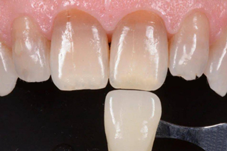 轻度四环素牙牙根变色图