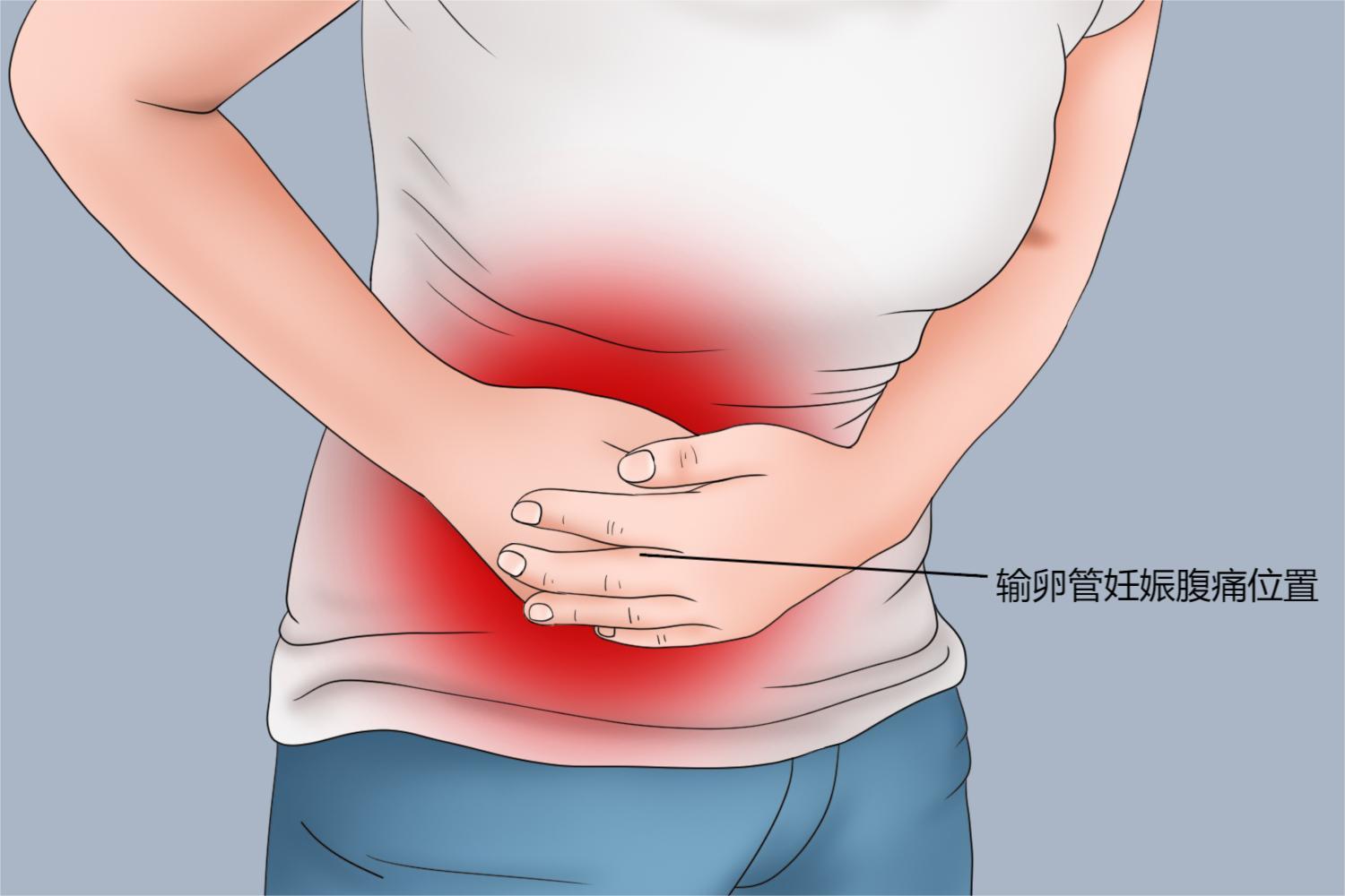 表现为一侧的隐痛或酸胀感;而随着病情加重,可能出现下腹部撕裂样疼痛