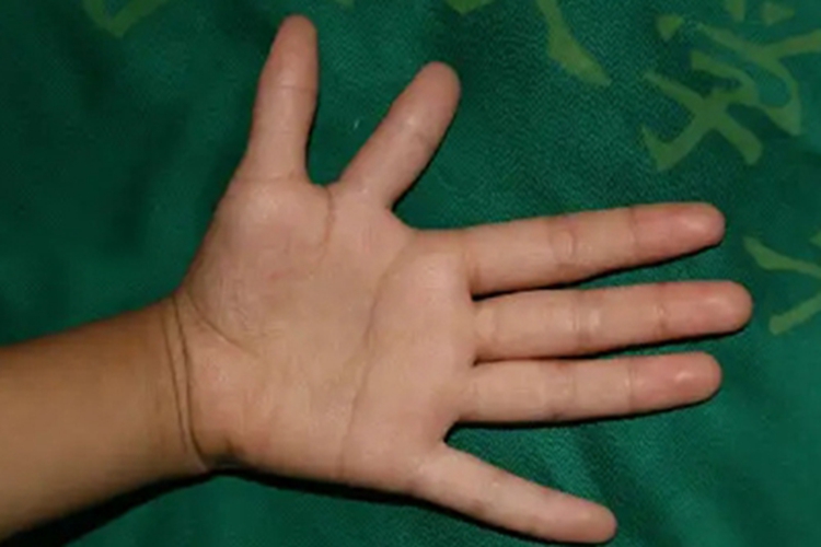 手部先天性畸形手部多指畸形图 手部先天性畸形手部多指畸形图