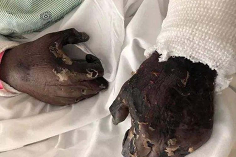 干性坏疽双手发黑图