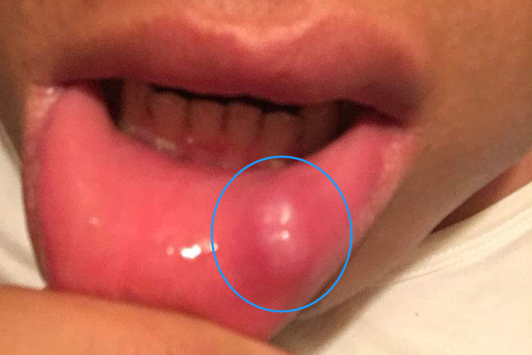 嘴唇撞击后有个紫红色硬疙瘩图