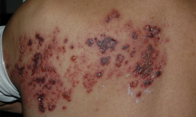 后背带状疱疹图 后背带状疱疹图