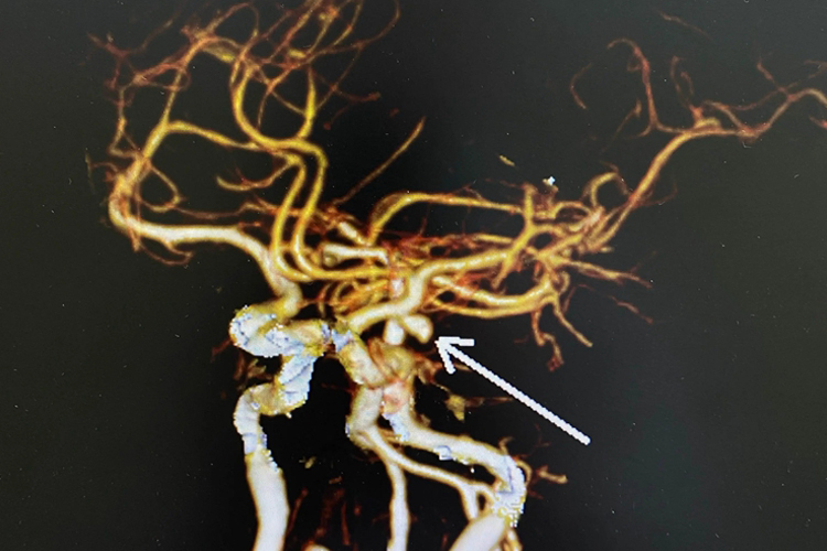 颅内动脉瘤图 颅内动脉瘤图