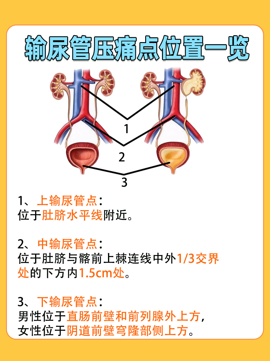 输尿管压痛点:身体内的“隐藏警报器”