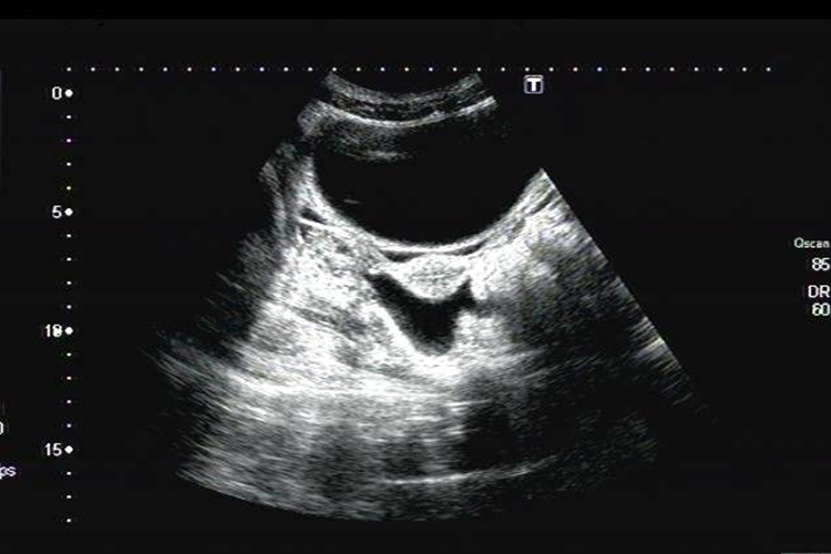 生理性盆腔积液影像图 生理性盆腔积液影像图