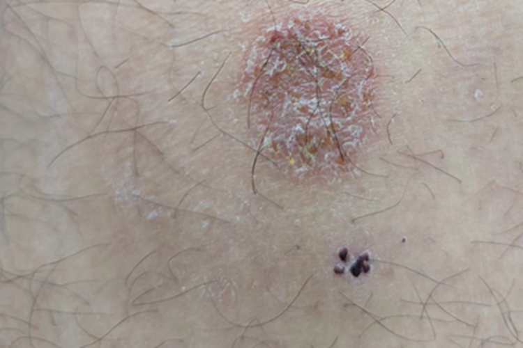 钱币状湿疹大腿症状图