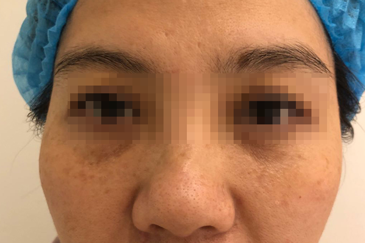 整个眼眶发黑的黑眼圈图