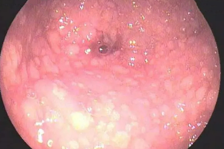 淡黄色结节型图