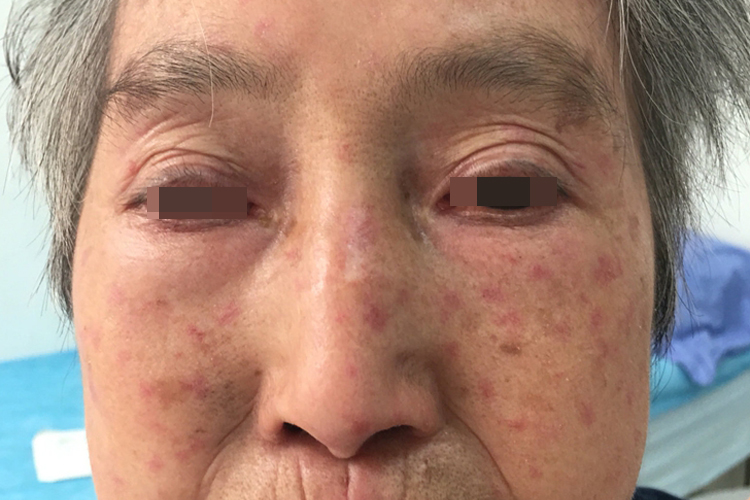 系统性硬化症硬化期图