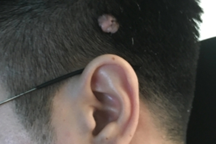 经典型上皮样肉瘤头皮疙瘩图