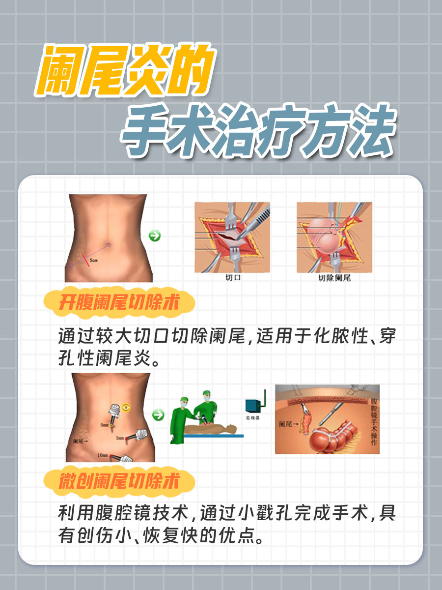 阑尾炎吃什么药可以缓解疼痛?一文解析