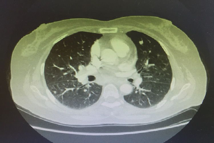 肾癌血行转移至肺图