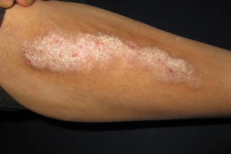 局限性神经性皮炎小腿脱屑图 局限性神经性皮炎小腿脱屑图