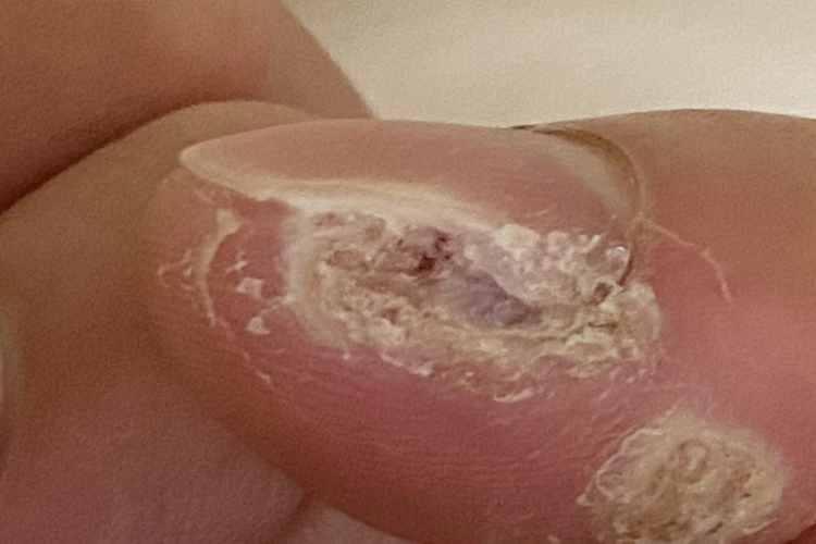 甲下疣图 甲下疣图