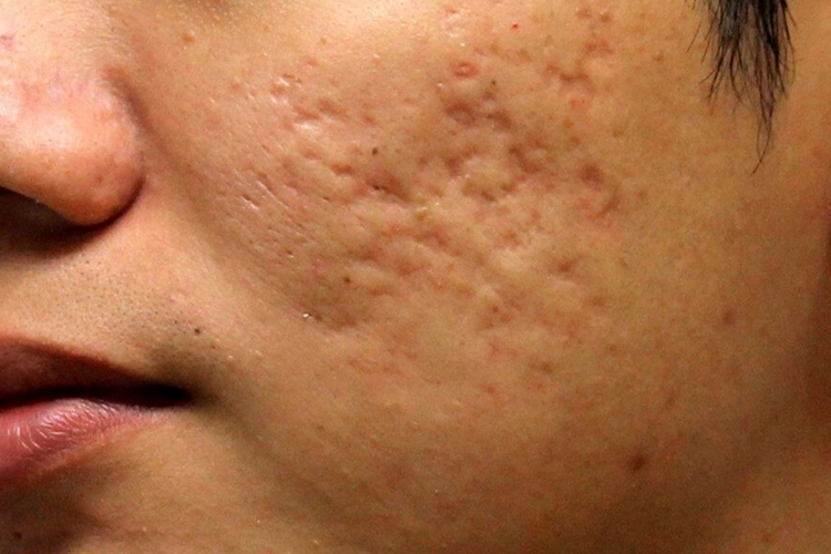 类脂蛋白沉积症瘢痕图