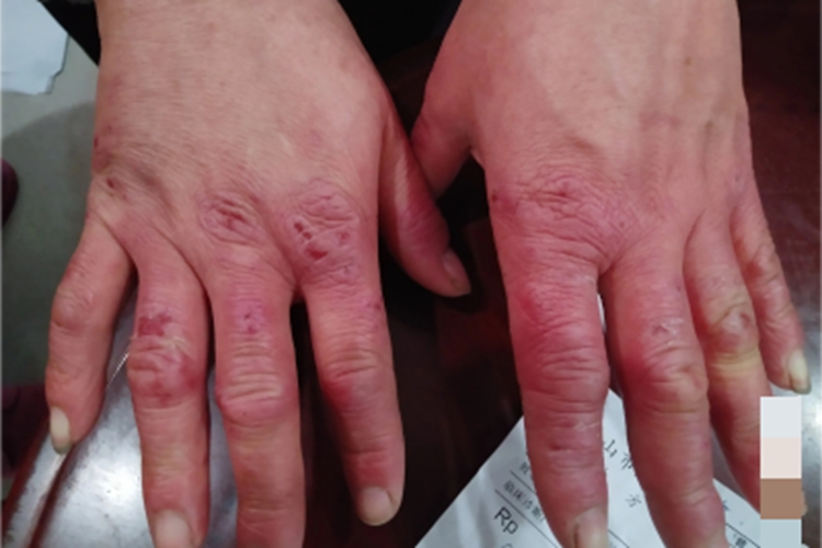 冷凝集素综合征手背症状图
