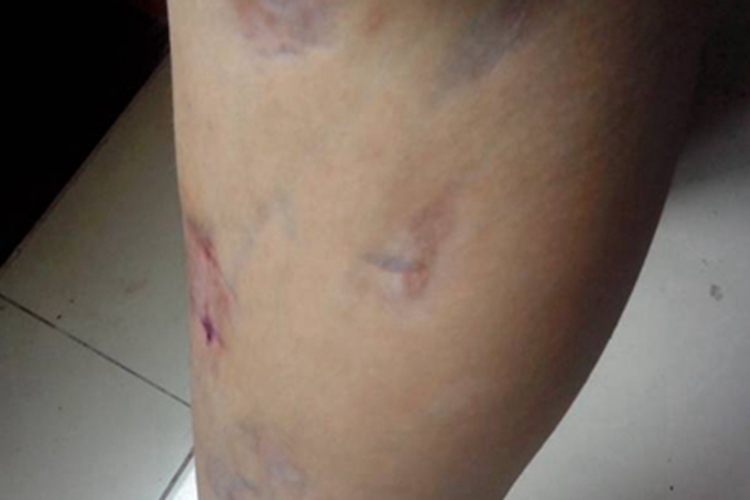 进行性特发性皮肤萎缩小腿有坑图