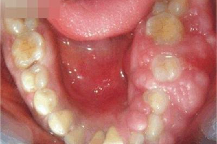 牙龈瘤下牙龈肿大肥厚图 牙龈瘤下牙龈肿大肥厚图