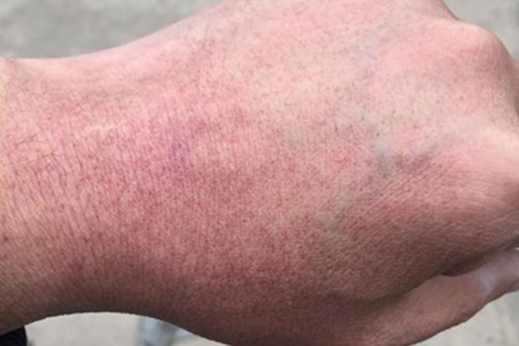 异常蛋白血症紫癜手背紫斑图